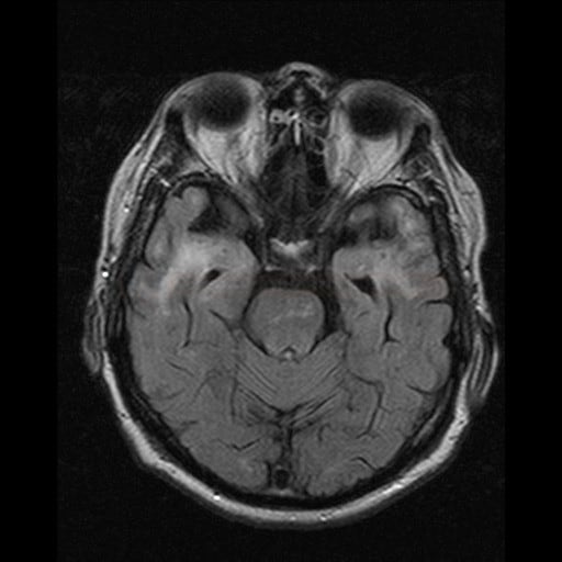 Radiation-induced encephalopathy (FLAIR)