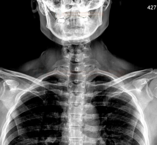 BIlateral cervical rib as a cause of Thoracic Outlet Syndrome