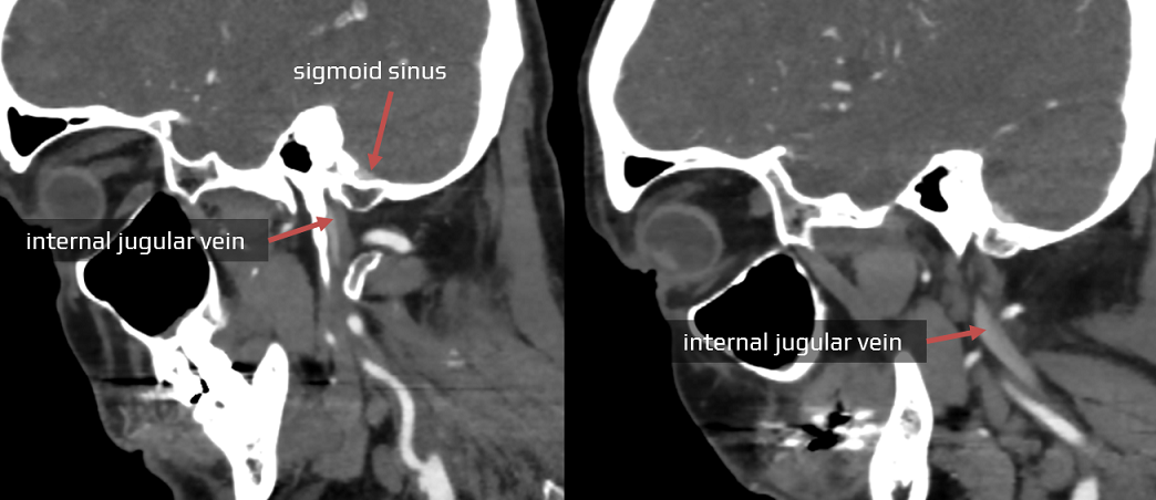 Internal jugular vein (IJV) on CTA