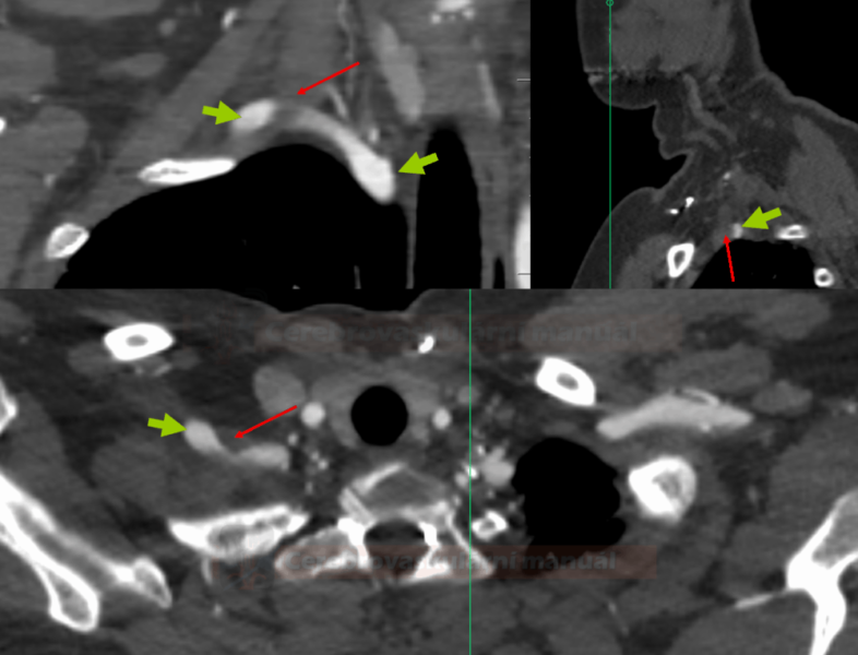 CT angiography in a patient with neurogenic TOS on the right side (green arrow - subclavian artery, red arrow - anterior scalene muscle)