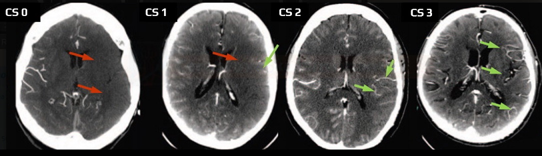 Collateral Score (CS) assessed on CT angiography source images