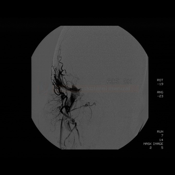 Dural arteriovenous fistula (DAVF) on DSA