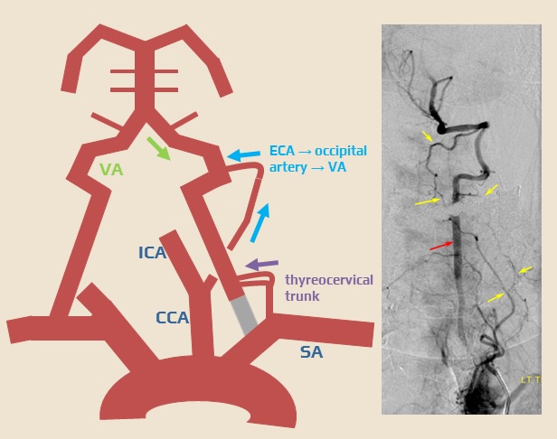 Extracranial anastomoses in vertebral artery occlusion
