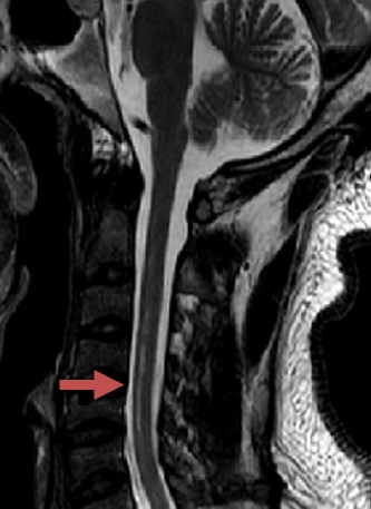 Spinal cord infarction due to dissection in the V4 segment of the vertebral artery