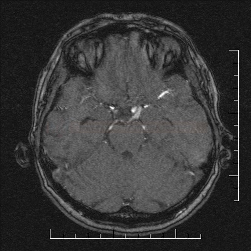 Aneurysm of the intracranial ICA segment