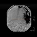 Cerebral arteriovenous malformation (DSA)