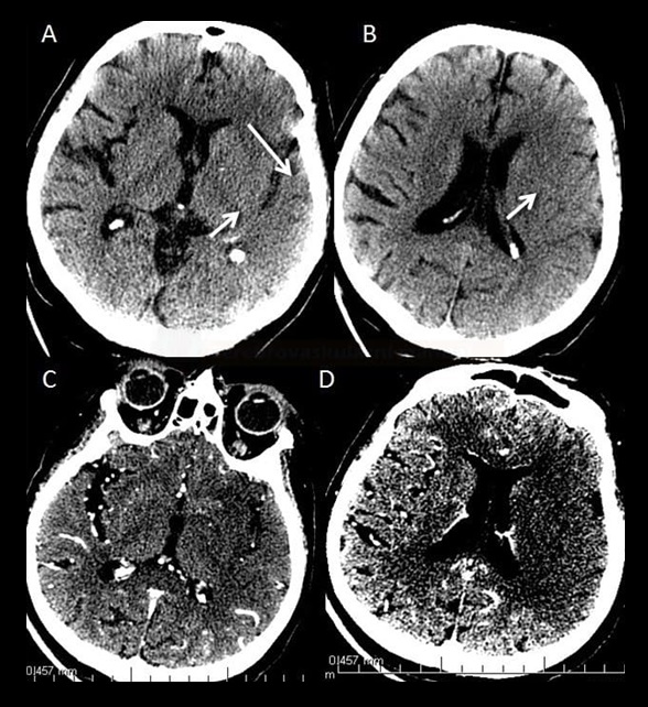 Early CT signs of ischemia on NCCT (A,B) and hypoperfusion on CT angiography source images ("CTA perfusion") (C,D)