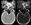 CT angiography (CTA) source images. A - standard image settings (W300/L30) B - adjusted window width and level (W730/ L310)