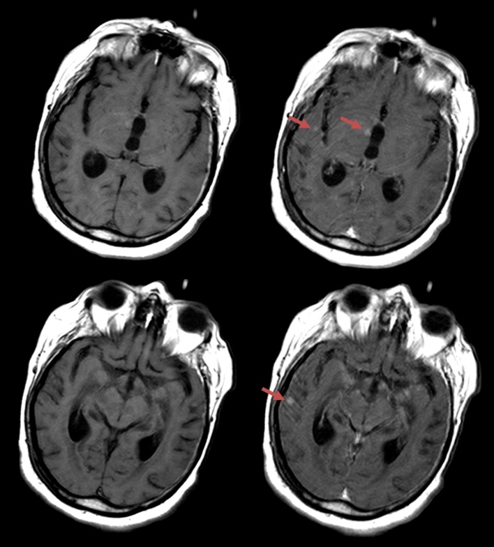 Gadolinium-based contrast agents (GBCAs) enhance pathological lesions on MRI