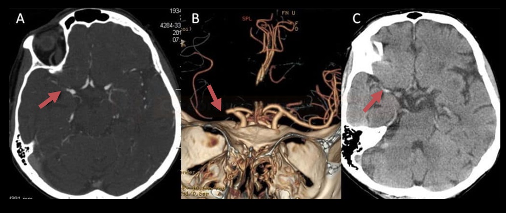 M1 segment occlusion on CTA and NCCT (with a dense artery sign)