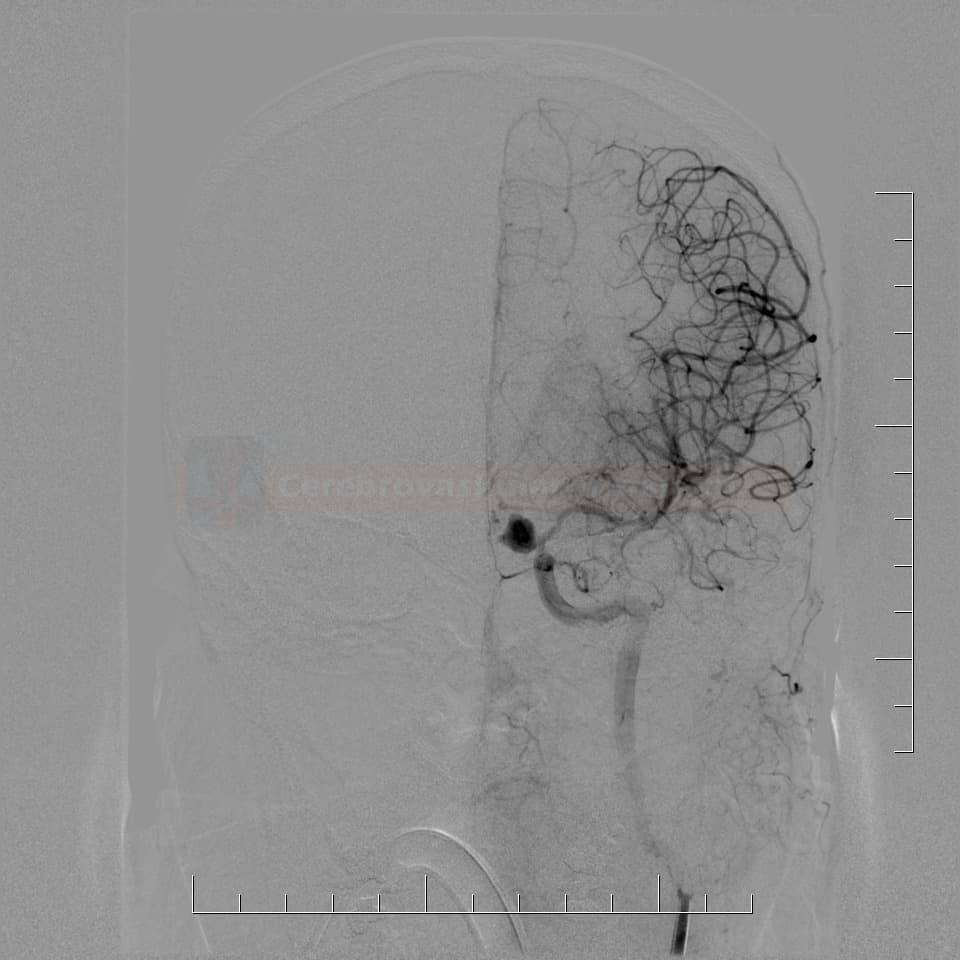 Aneurysm of the ICA siphon