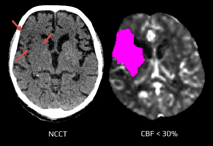 Early CT signs of ischemia on NCCT