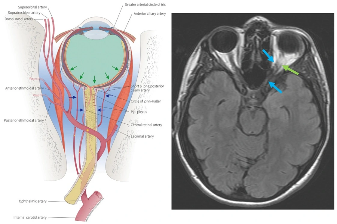 Ophthalmic artery (blue arrow) and its branches (green arrow = lacrimal artery)