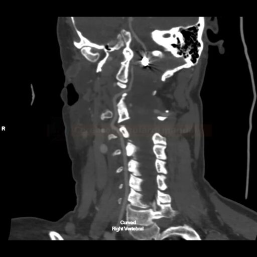 Follow-up CTA - coiling of PICA aneurysm