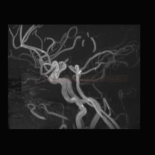 Follow up of a patient with coiled PICA aneurysm