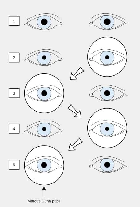 Relative afferent pupilary defect (RAPD)