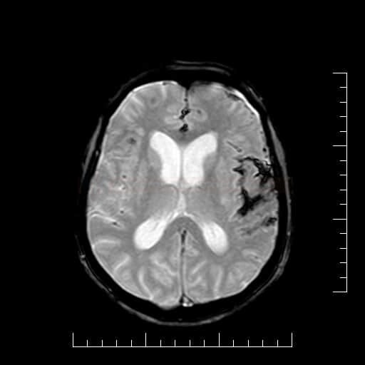 Subarachnoid hemorrhage caused by rupture of na ICA aneurysm (GRE)