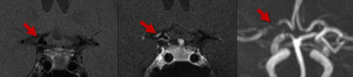 Demonstration of ICA vasculitis using post-contrast high resolution MRI (HRMRI) (Obuses, 2014)