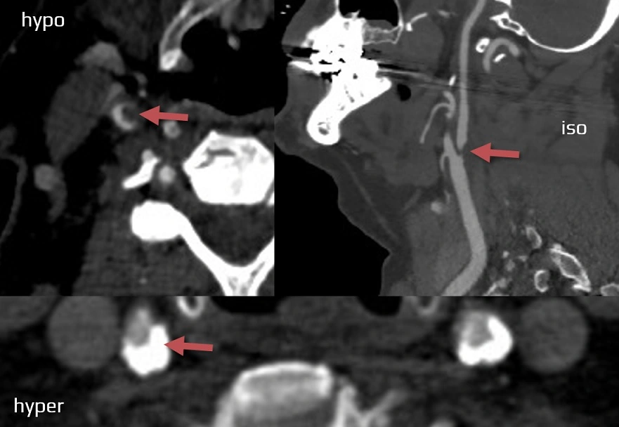 Hypodense, isodense and hyperdense plaque on CTA