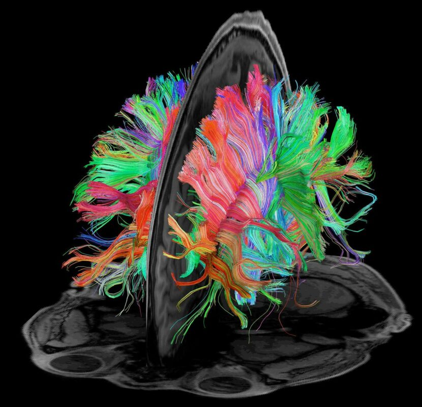 diffusion tensor imaging (DTI tractography