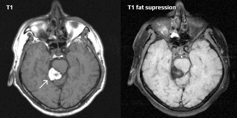 T1 fat-supressed sequence showing lipoma