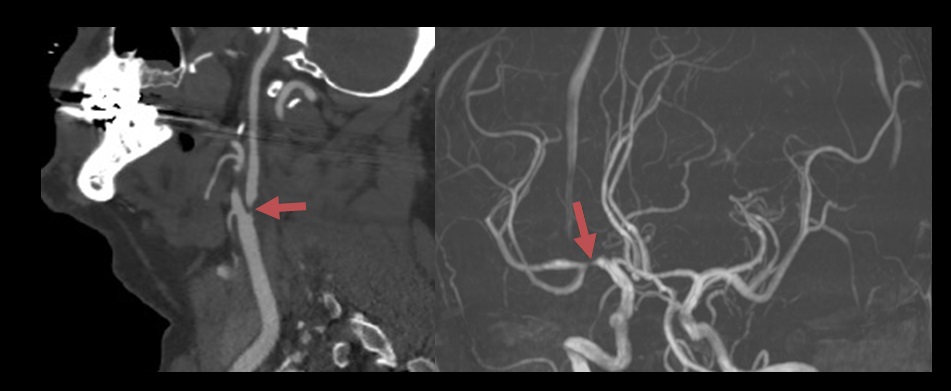 Large artery atherosclerosis (LAA)