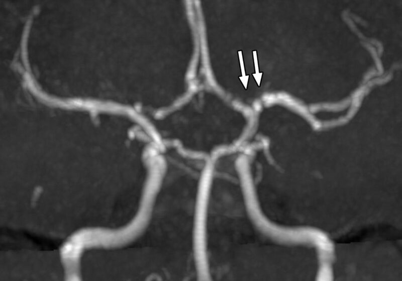 Focal cerebral arteriopathy on MRA