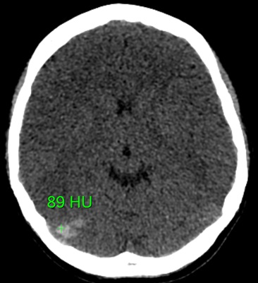 The right sigmoid and straight sinus thrombosis - hyperdense sign with 80HU