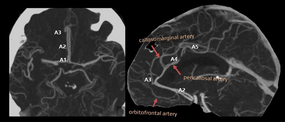 Anterior cerebral artery segments