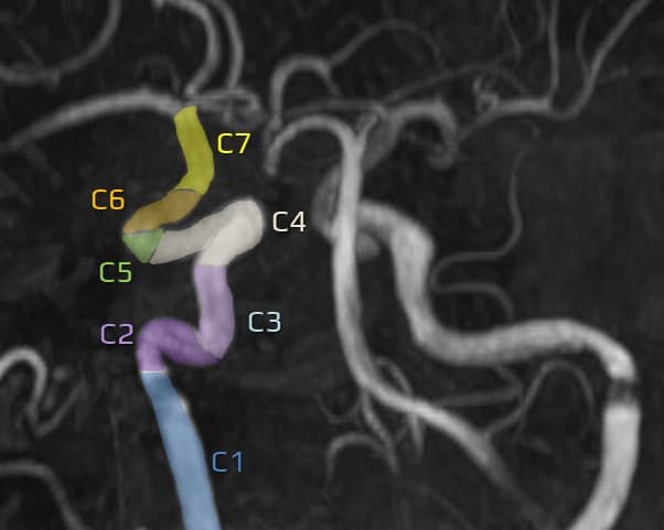 Anatomy of cerebral arteries