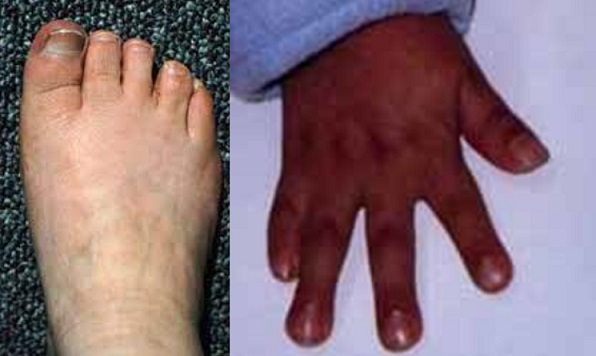 Grange syndrome - brachydactyly and syndactyly