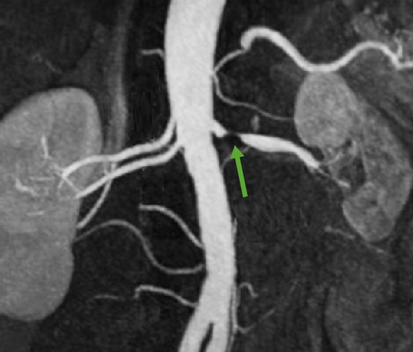 Renal artery stenosis on MRA