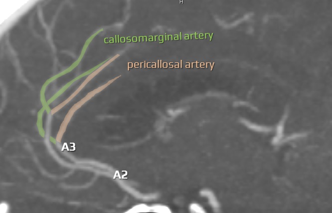 Callosomarginal and pericallosal arteries