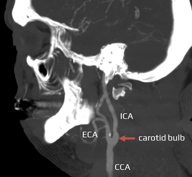 Carotid bifurcation - the division of the common carotid artery (CCA) into the internal (ICA) and external (ECA) carotid arteries