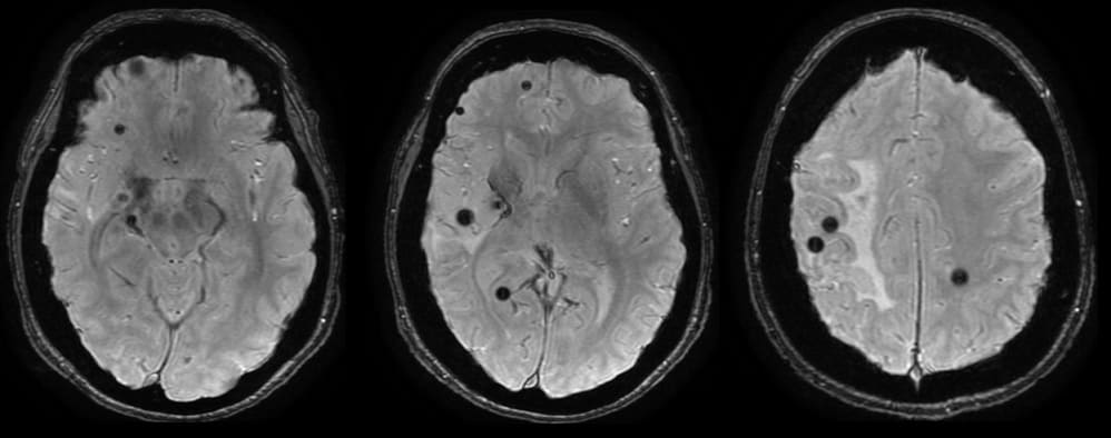 Multiple cavernous malformations (MRI SWAN)