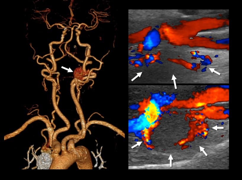 Carotid body tumor on CTA and ultrasound (color flow mode)