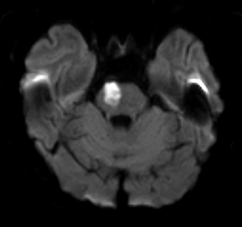 Probable Branch Artery Disease (BAD) leading to pontine infarct. CTA revealed no stenosis in extra- and intracranial parts of posterior circulation