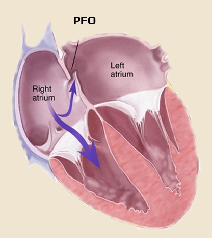 Patent Foramen Ovale (PFO)