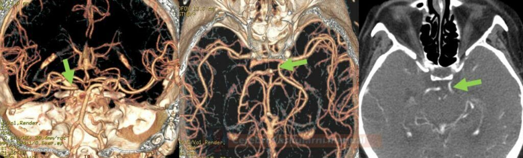 Fetal posterior cerebral artery (PCA) on CTA