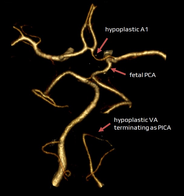 Hypoplastic vertebral artery (VA) terminating as PICA. Hypoplastic A1 segment and fetal PCA.