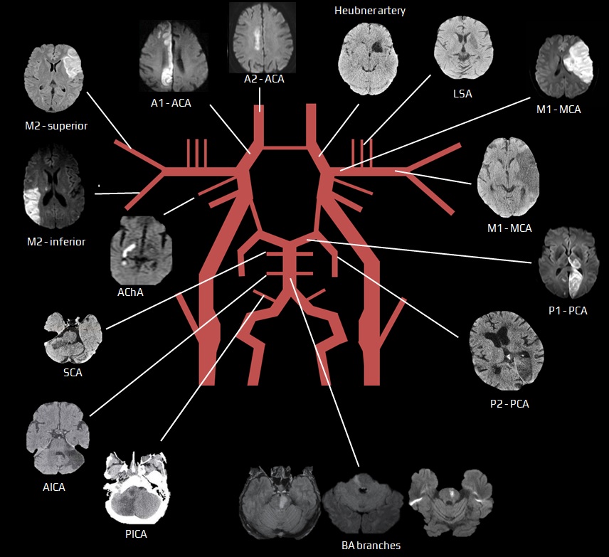 Intracranial arterial territories