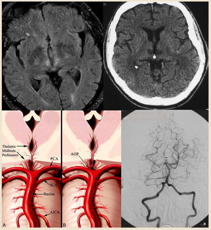 Bithalamic infarction due to an occlusion of Percheron artery