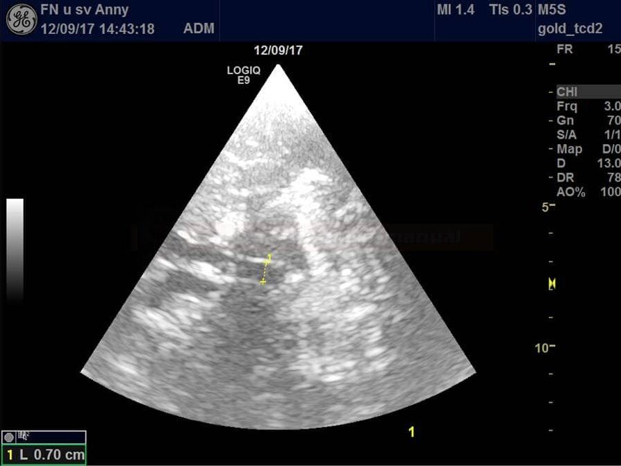 Measurement of the third ventricle on the ultrasound