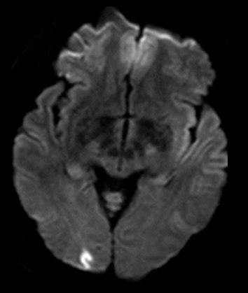 Young female migraineur complained of prolonged visual aura and vertigo followed by migrainous headache. DWI demonstrated small cortical infarction in the right occipital lobe