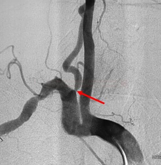 Stenosis in the V0 segment of vertebral artery on DSA