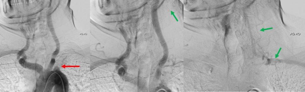 Vertebral steal on DSA. Green arrow shows retrograde filling of vertebral artery and subclavian artery