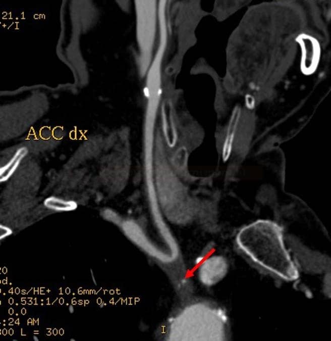 Occlusion of the brachiocephalic trunk on CTA