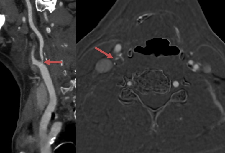 Significant internal carotid artery stenosis on CTA