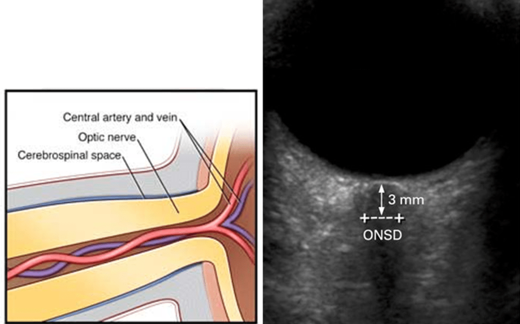 Optic Nerve Sheath Diameter (ONSD)