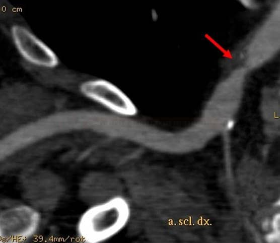 Subclavian artery stenosis on CTA